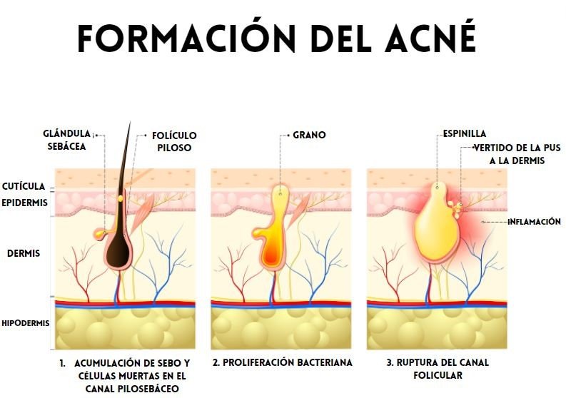 ACNÉ AND STEROIDS