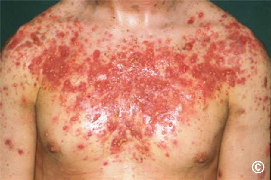 ACNÉ AND STEROIDS