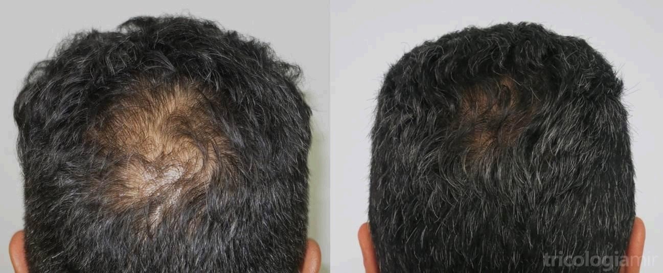 Steroids and Alopecia Steroids and Alopecia