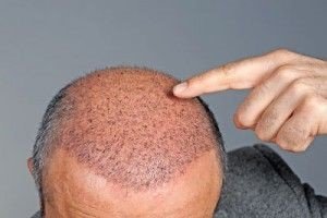 Steroids and Alopecia Steroids and Alopecia