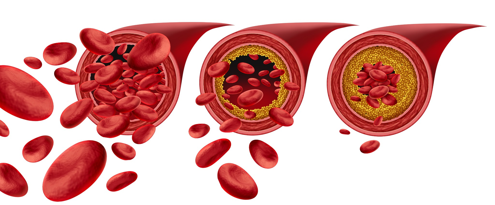 Blood Pressure During Steroids Atherosclerosis and arterial stiffness