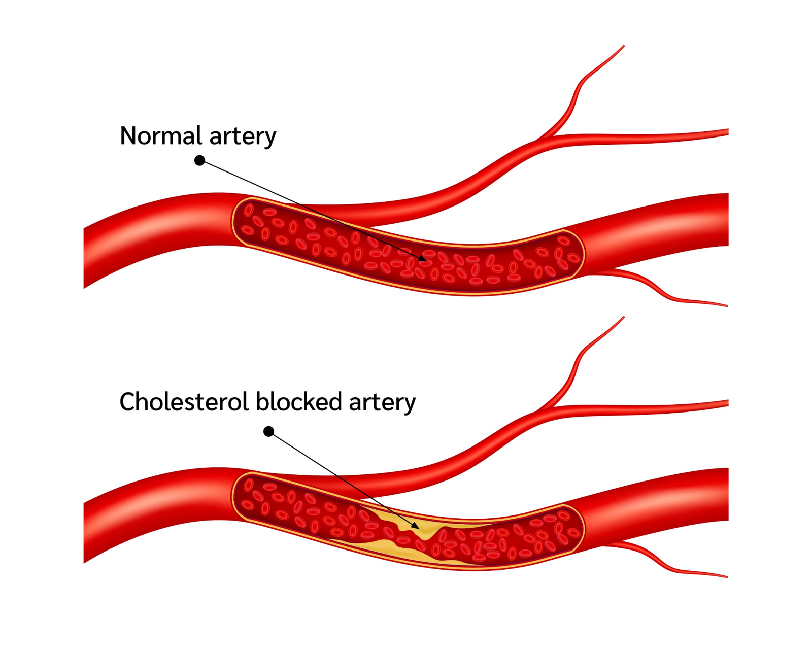 Blood Pressure During Steroids Cholesterol and atherosclerosis