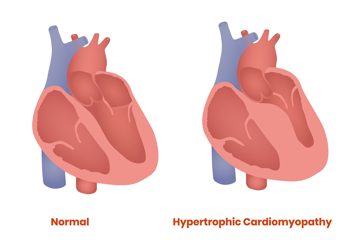 Blood Pressure During Steroids Heart and left ventricular hypertrophy